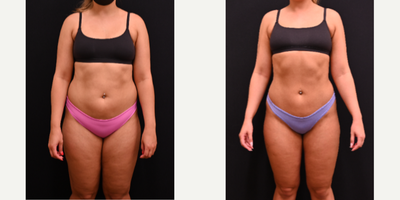 Liposuction before and after photo
