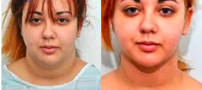 Smart Lipo before and after photo
