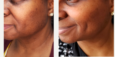 YAG Laser before and after photo