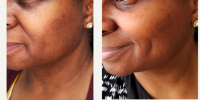 YAG Laser before and after photo