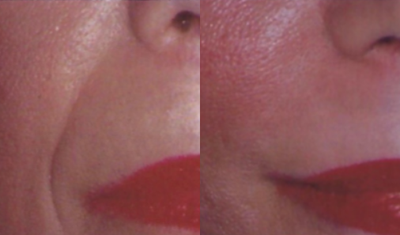 Bellafill before and after photo