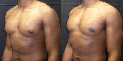 Gynecomastia Surgery before and after photo