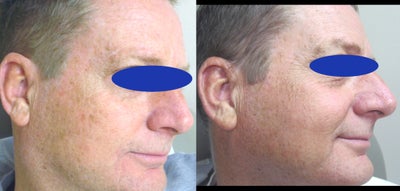Chemical Peel before and after photo