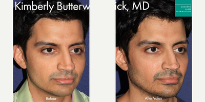 Dermal Fillers before and after photo