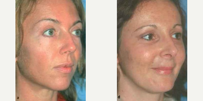 Facial Fat Transfer before and after photo
