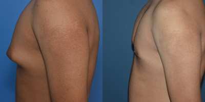 Gynecomastia Surgery before and after photo