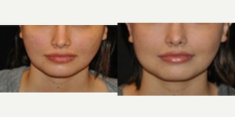 Jaw Reduction before and after photo