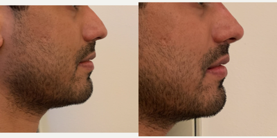 Nonsurgical Nose Job before and after photo