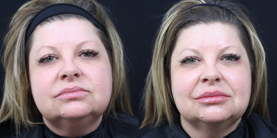 Dermal Fillers before and after photo
