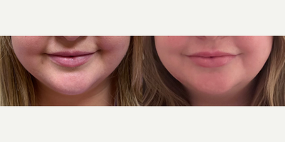 Lip Fillers before and after photo
