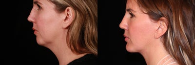 Chin Implant before and after photo