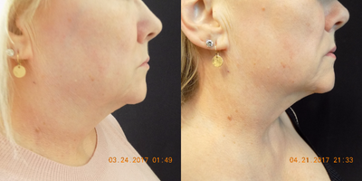 CoolSculpting before and after photo
