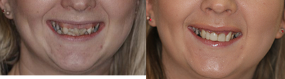 Dental Bonding before and after photo