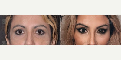 Facelift before and after photo