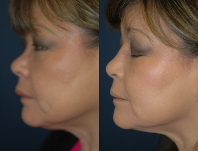 Rhinoplasty before and after photo