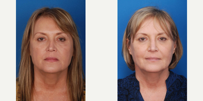 Rhinoplasty before and after photo