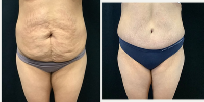 Tummy Tuck before and after photo