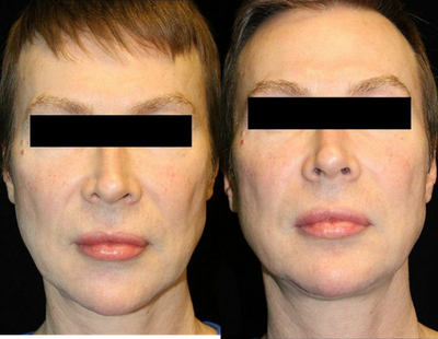 ArteFill before and after photo