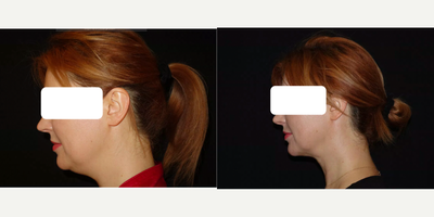 Chin Liposuction before and after photo