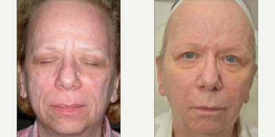 Fraxel Laser before and after photo