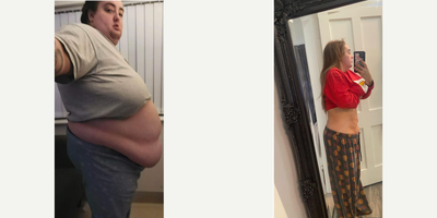 Gastric Sleeve Surgery before and after photo