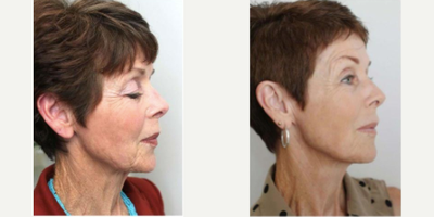Microneedling before and after photo