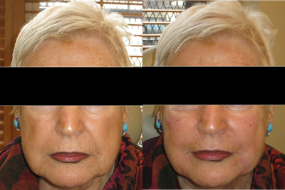 Radiesse before and after photo