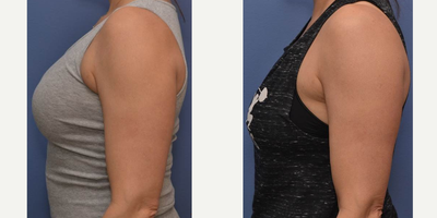 Ultherapy before and after photo