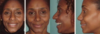 African American Rhinoplasty before and after photo