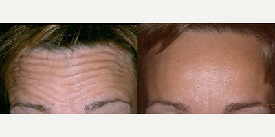 Botox before and after photo