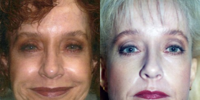 Brow Lift before and after photo