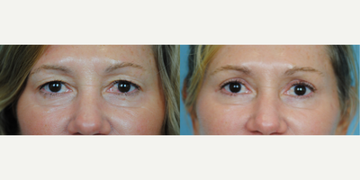 Eyelid Surgery before and after photo