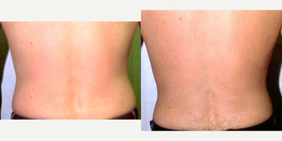 Tumescent Liposuction before and after photo