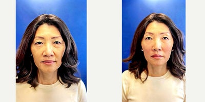 Dermal Fillers before and after photo