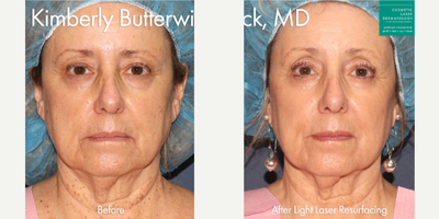 Laser Resurfacing before and after photo