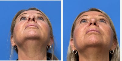 Rhinoplasty before and after photo