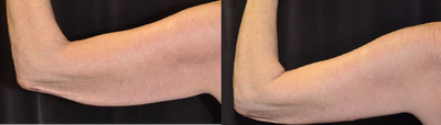 Arm Lift before and after photo
