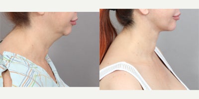 Neck Lift before and after photo