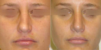 Rhinoplasty before and after photo