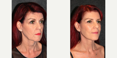 Deep Plane Facelift before and after photo