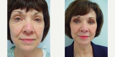 Facelift before and after photo