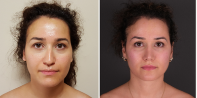Rhinoplasty before and after photo