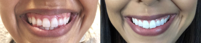 Botox for Gummy Smile before and after photo