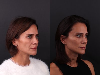 Brow Lift before and after photo