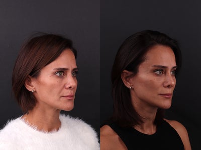 Brow Lift before and after photo