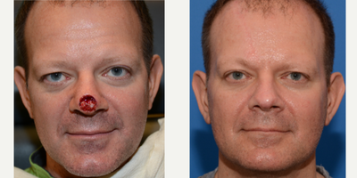 Facial Reconstructive Surgery before and after photo