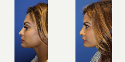 Revision Rhinoplasty before and after photo