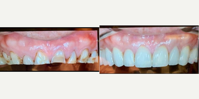 Smile Makeover before and after photo