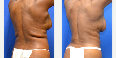 Body Lift before and after photo