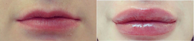 Lip Fillers before and after photo